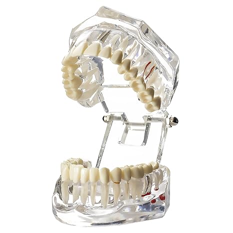 Dental Implant Models Restoration Typodont Teeth Tooth Model Demo Oral Pathology Bridge Teach Study Clear Color M2001