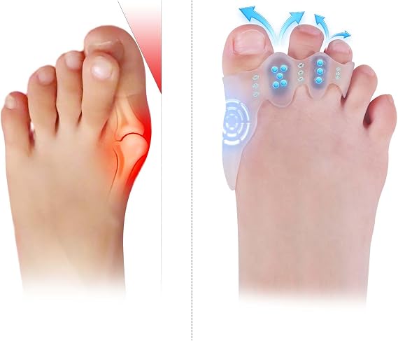 Toe Spacers & Bunion Corrector for KidsMenWomen|Corn Callus Removers|Bunion Relief|Overlapping Toes Separators (Toe Corrector Set (1 Pair, 20 ct Fillers), Small-Kids)